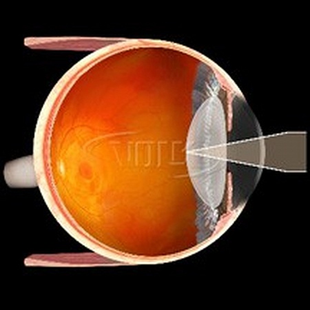 Линза Volk Capsulotomy Lens для аргоновых, диодных и YAG лазеров от «ХайтекМед»