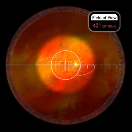 Хирургическая линза Volk Direct HR Direct 20° Prism для прямой офтальмоскопии от «ХайтекМед»