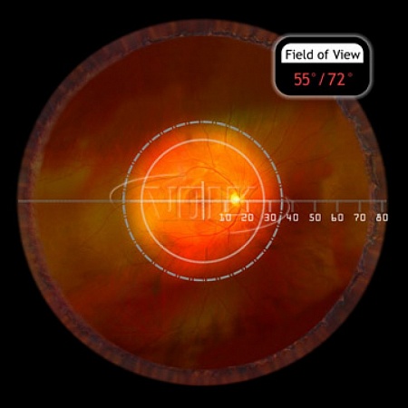 Линза Volk Digital Clear Field для непрямой офтальмоскопии (BIO) с использованием видеокамеры от «ХайтекМед»