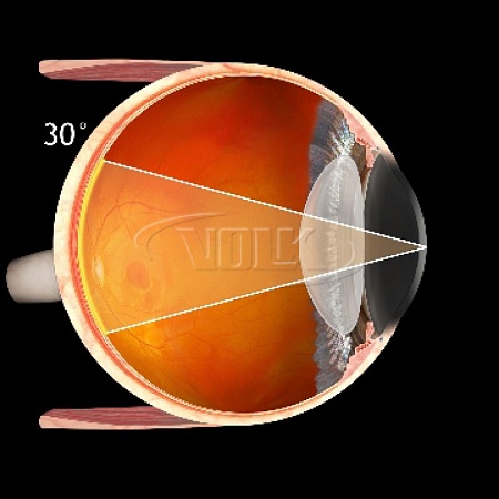 Хирургическая линза Volk Chalam AFX SSV® (ASC) для прямой офтальмоскопии с опцией самостабилизации от «ХайтекМед»