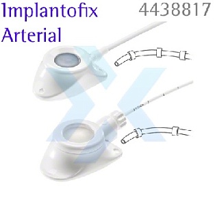 Порт-система для артериального доступа Celsite Implantofix Arterial  от «ХайтекМед»