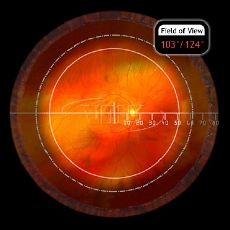 Линза Volk Digital Wide Field для непрямой офтальмоскопии (BIO) с помощью щелевой лампы с использованием видеокамеры от «ХайтекМед»