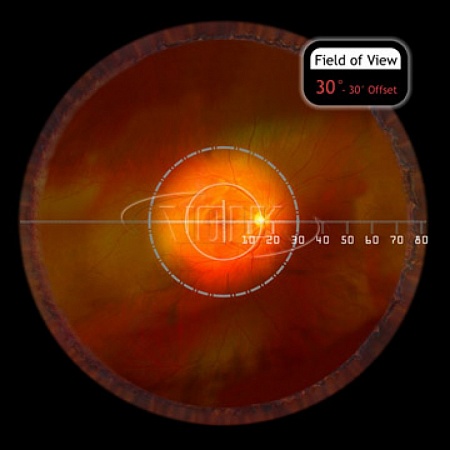Хирургическая линза Volk Chalam Flat SSV® (ASC) для прямой офтальмоскопии с опцией самостабилизации от «ХайтекМед»