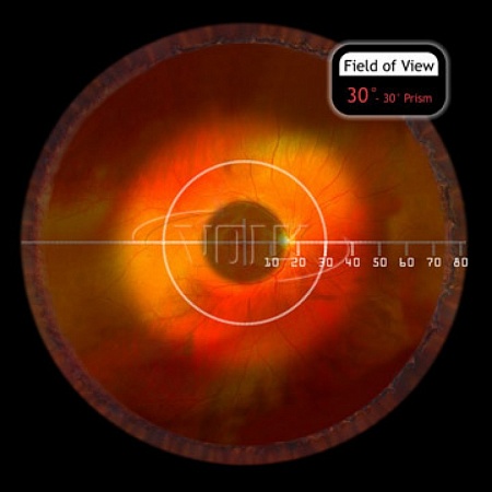 Хирургическая линза Volk Chalam 30° Prism SSV® (ASC) для прямой офтальмоскопии с опцией самостабилизации от «ХайтекМед»