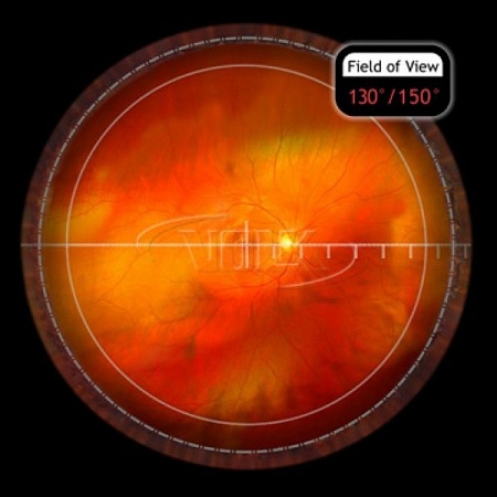 Хирургическая линза Volk HRX Vit Lens для непрямой офтальмоскопии от «ХайтекМед»