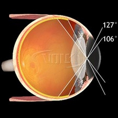 Хирургическая линза Volk MiniQuad® для непрямой офтальмоскопии от «ХайтекМед»