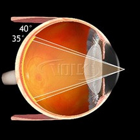 Контактная линза Volk Fundus Laser Lens для аргоновых и диодных лазеров от «ХайтекМед»