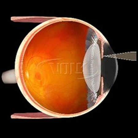 Линза Volk MagPlus Iridectomy Lens для аргоновых, диодных и YAG лазеров от «ХайтекМед»