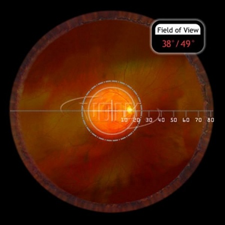 Линза Volk Digital Clear Mag для непрямой офтальмоскопии (BIO) с использованием видеокамеры от «ХайтекМед»
