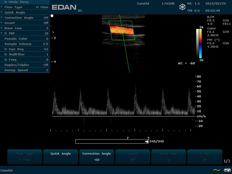 Портативный ультразвуковой аппарат EDAN U60 от «ХайтекМед»