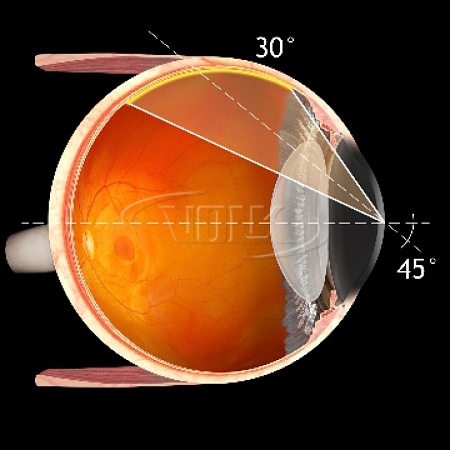 Хирургическая линза Volk Chalam 40° Prism SSV® (ASC) для прямой офтальмоскопии с опцией самостабилизации от «ХайтекМед»
