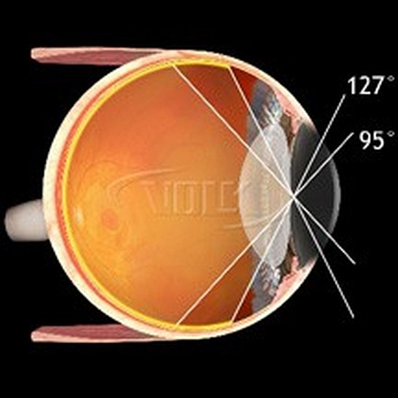 Хирургическая линза Volk Dyna View для непрямой офтальмоскопии от «ХайтекМед»